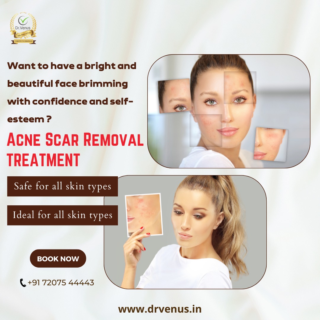 Acne Scar Removal Treatment In Hyderabad 16895808636