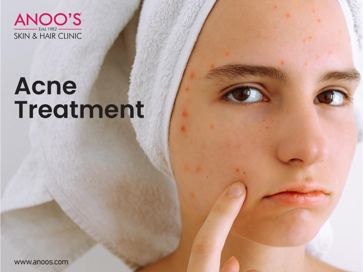 Advanced Acne Removal Treatment At Anoos 17429754158
