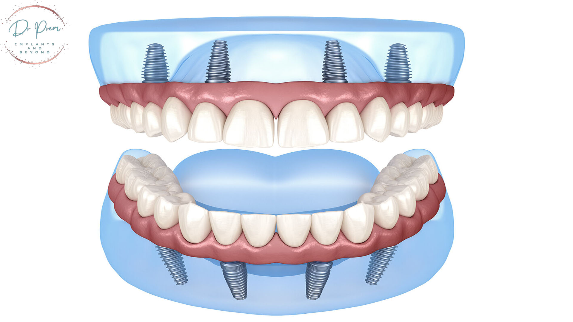 All On Four Dental Implants Cost 17025303623