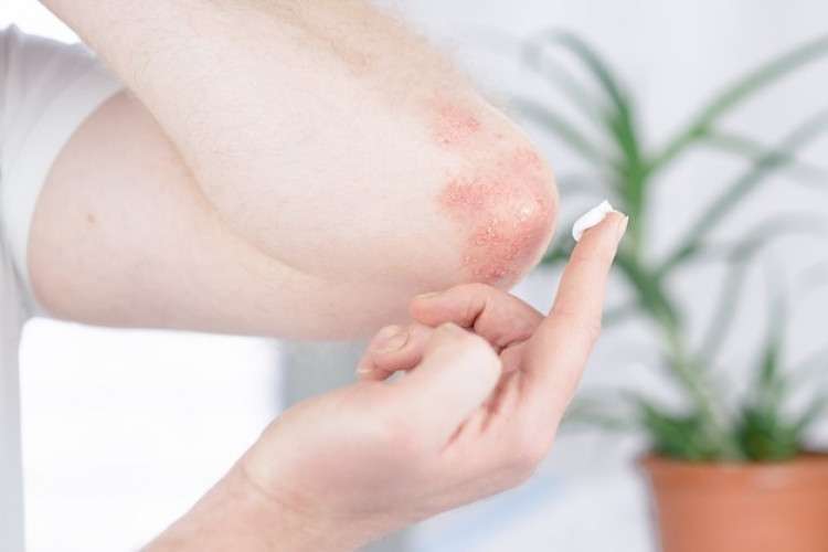 Ayurvedic Psoriasis Treatment 16392165699