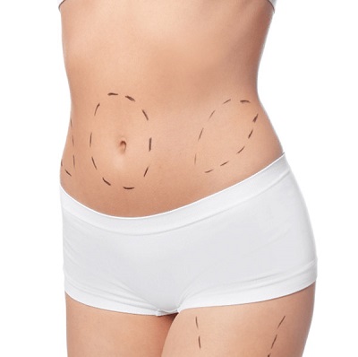 Best Abdominoplasty Surgery In Bangalore 16730946003