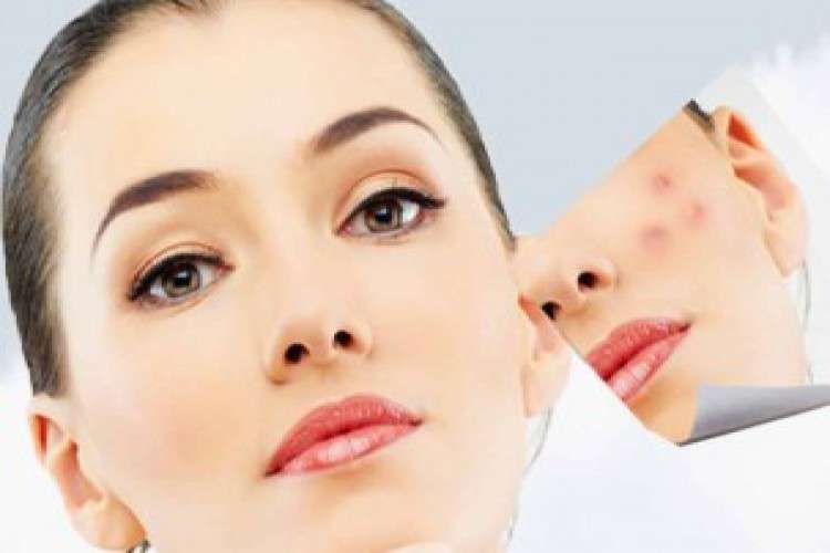 Best Acne Scar Treatment In Punjab 1350089