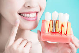 Best Dental Implants   Sendhil Dental 16914713412