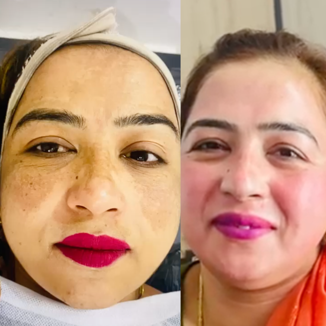 Best Dermatologist In Chandigarh   Gleuhr Clinic 17385654261