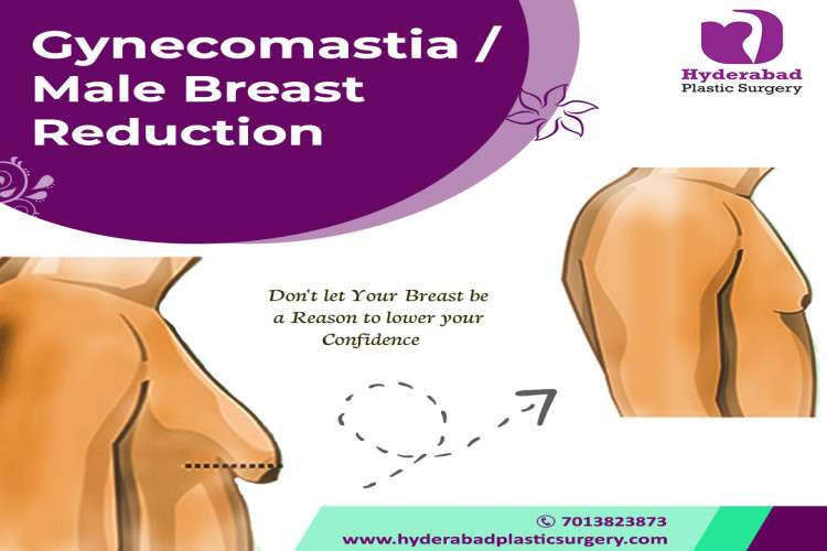Best Gynecomastia Surgery In Hyderabad 16478442580