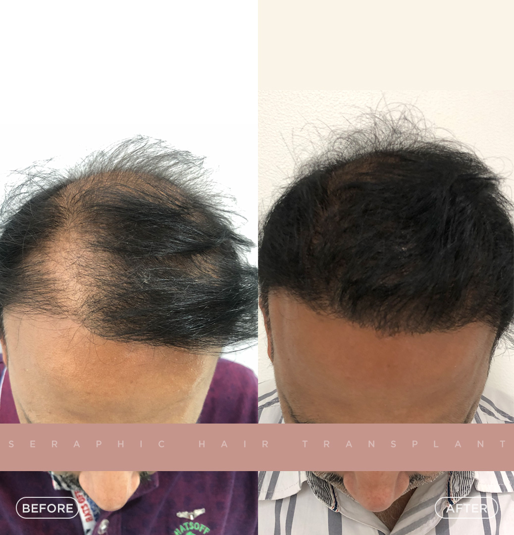 Best Hair Transplant In Indore Advanced And Trusted Hair Restoration 17587971557