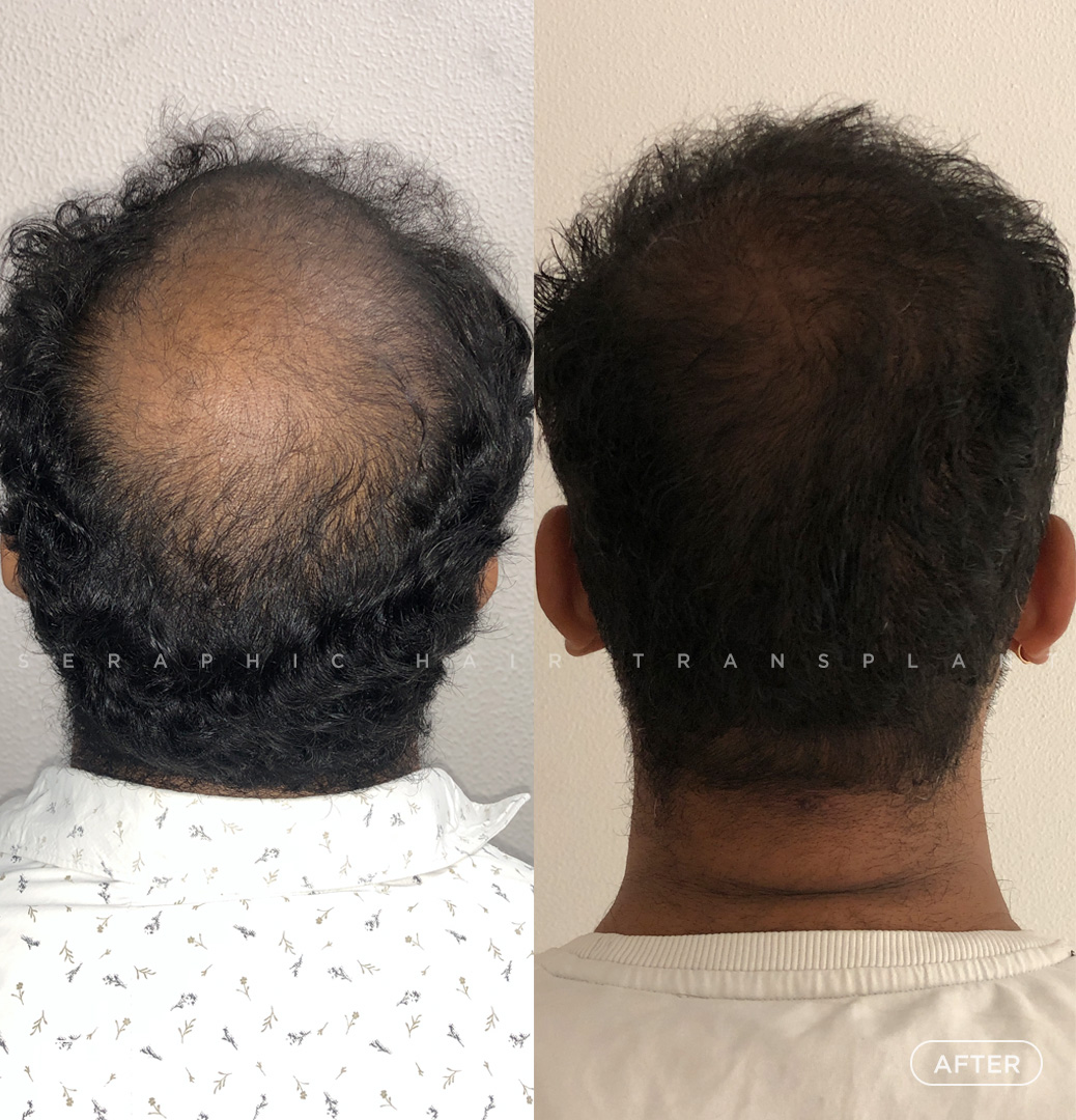Best Hair Transplant In Indore Advanced And Trusted Hair Restoration 17587971558
