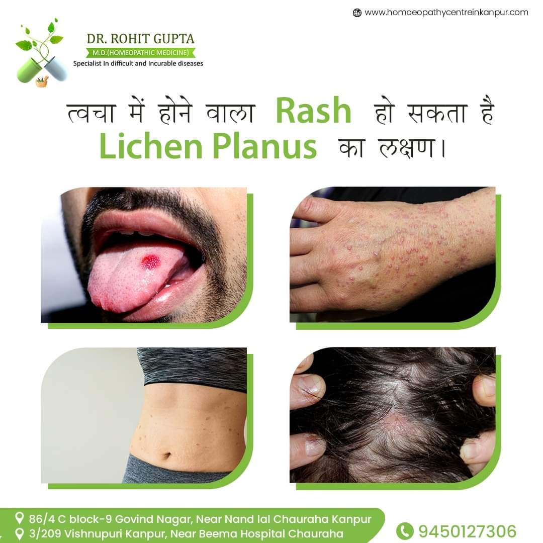 Best Pimples Acne Treatment In Kanpur Dermatologist Near Me 16762698475