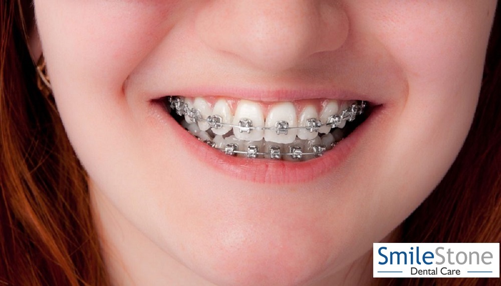 Best Smile Design In Nagpur 17332178493