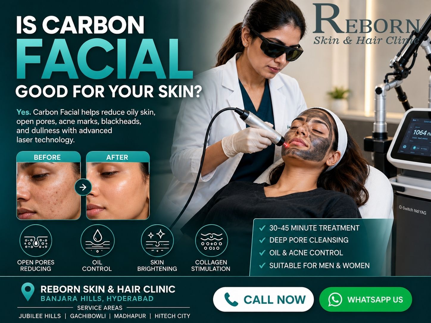 Carbon Facial For Oily Skin And Open Pores In Banjara Hills 17818443881