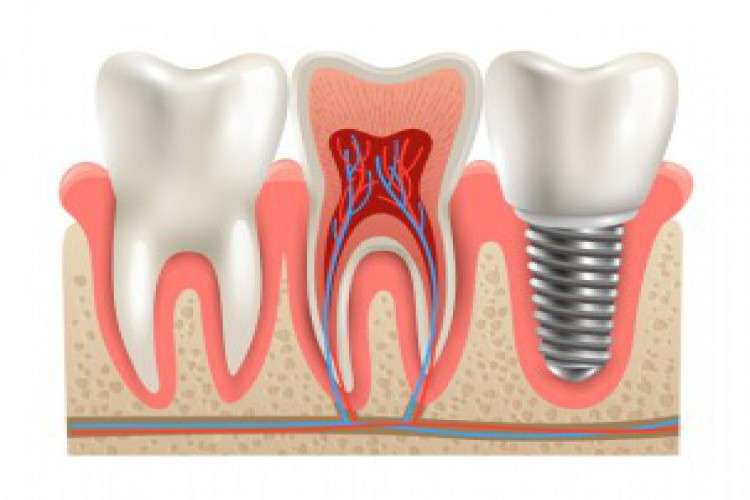 Dental Implants In Dubai 6745078
