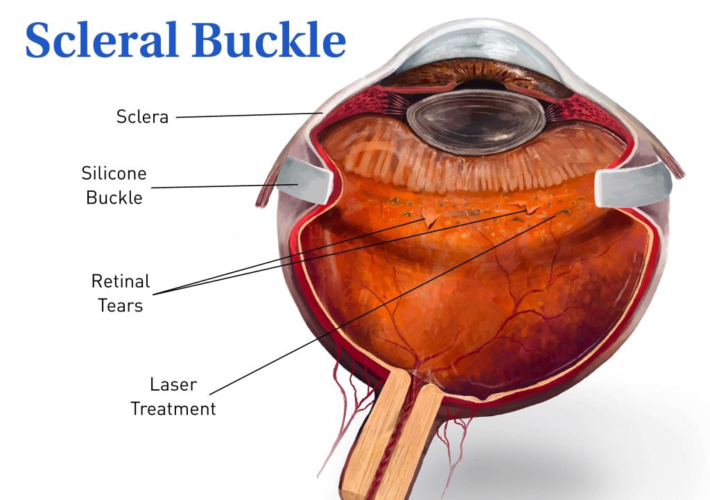 Eye Hospital For Scleral Buckle Surgery Near Medanta Hospital Indore 17537790783