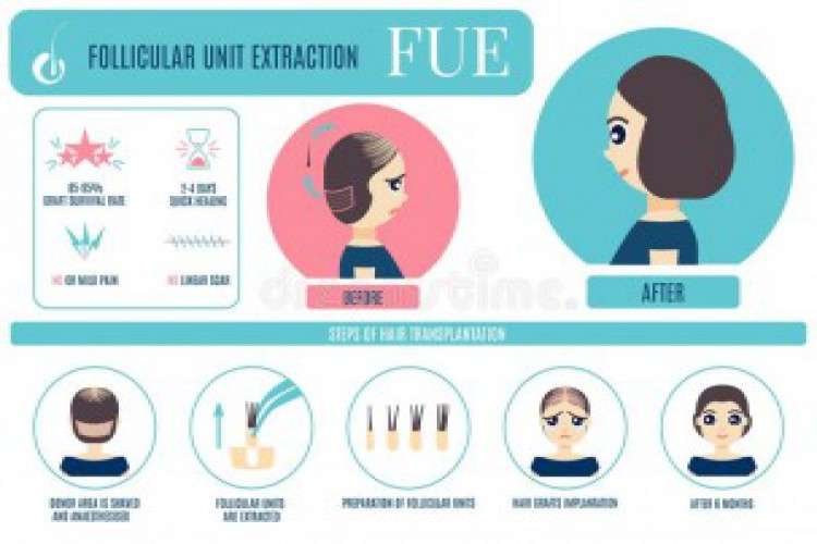 Fue Hair Transplant Clinic In Chandigarh 8566851