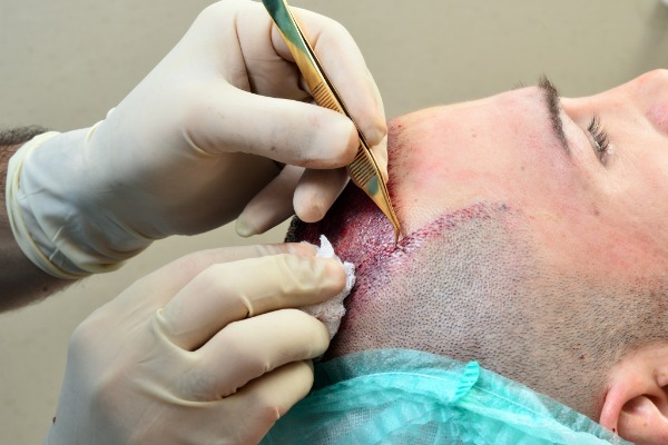 Hair Transplantation Cost In Jaipur 16587338054