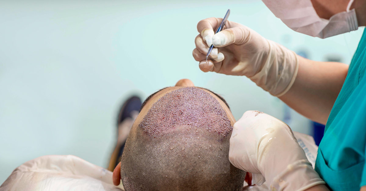 Hair Transplantation Cost In Jaipur 16587338057