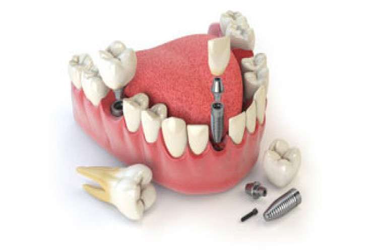 Immediate Dental Implants In Guntur 16375791819