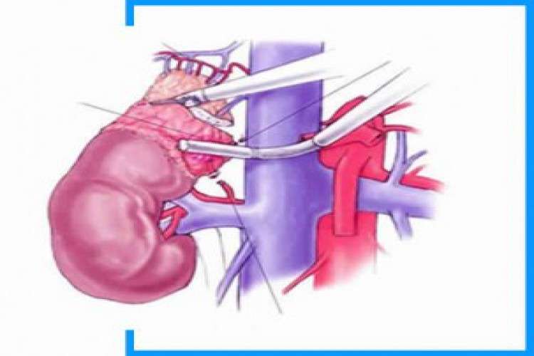 Intra Abdominal Laparoscopic Surgeries 7674371