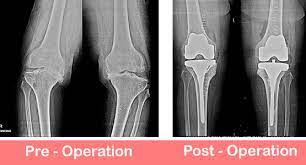 Knee Replacement Surgeon In Delhi 17013374618