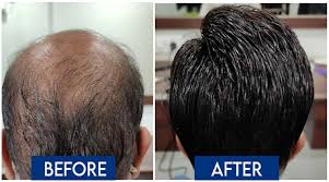 Ladensitae   Best And Affordable Hair Transplant Clinic In Pune 17133512806