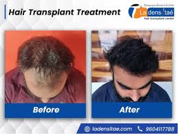 Ladensitae   Best And Affordable Hair Transplant Clinic In Pune 17133512807