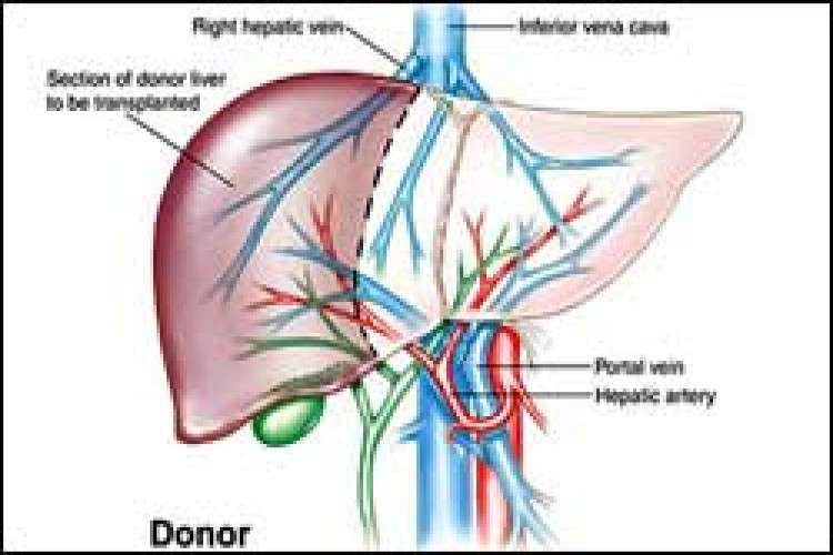 Low Cost Liver Transplant In India By Transplantliverindia 163359360910