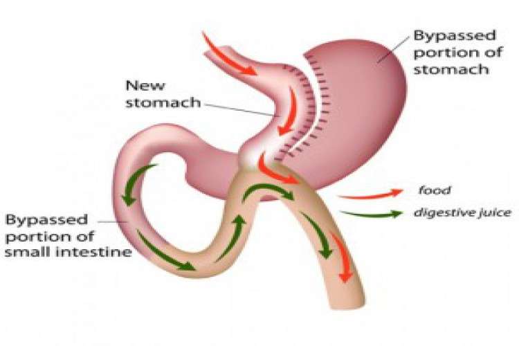 Mini Gastric Bypass Surgery In India 6411412