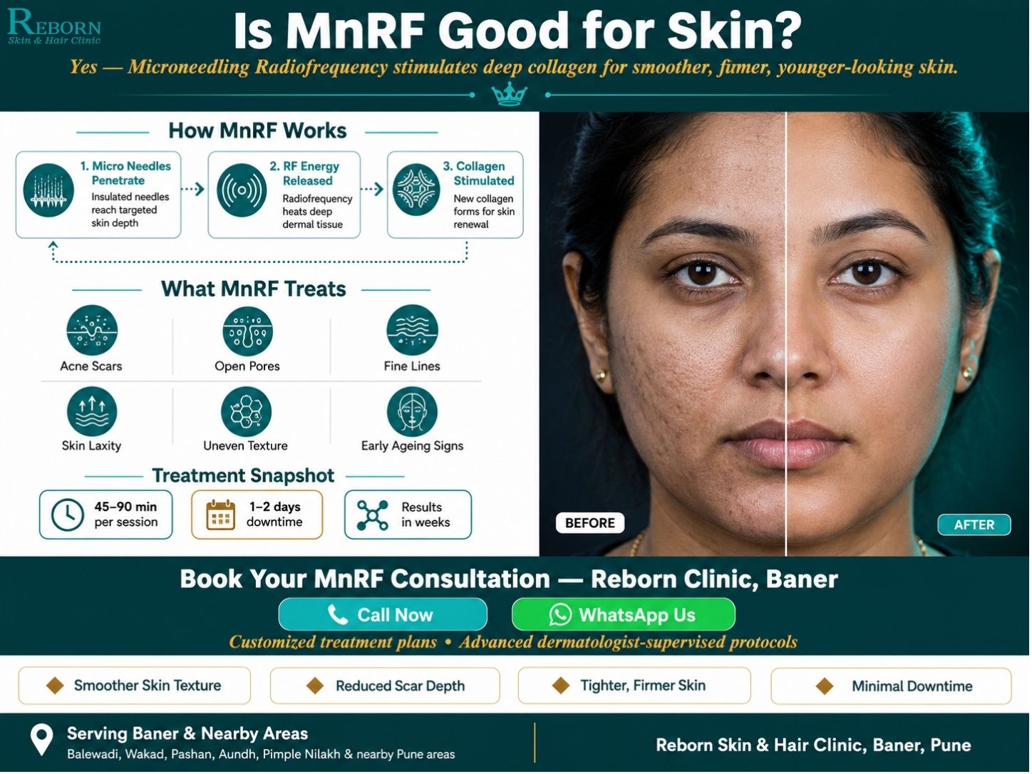 Mnrf Treatment Near Wakad In Baner 17831516308