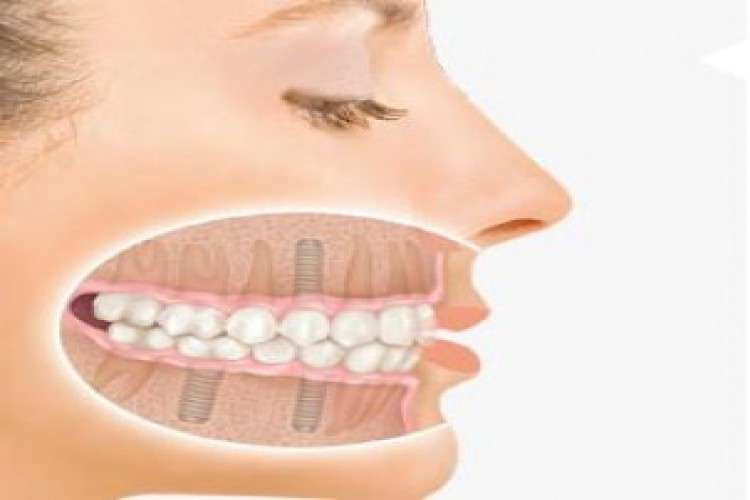 Painless Root Canal Treatment In Chandigarh 6911257