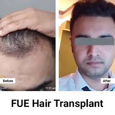 Skin Whitening And Hair Transplant Services In Lahore And Faisalabad 17677212156