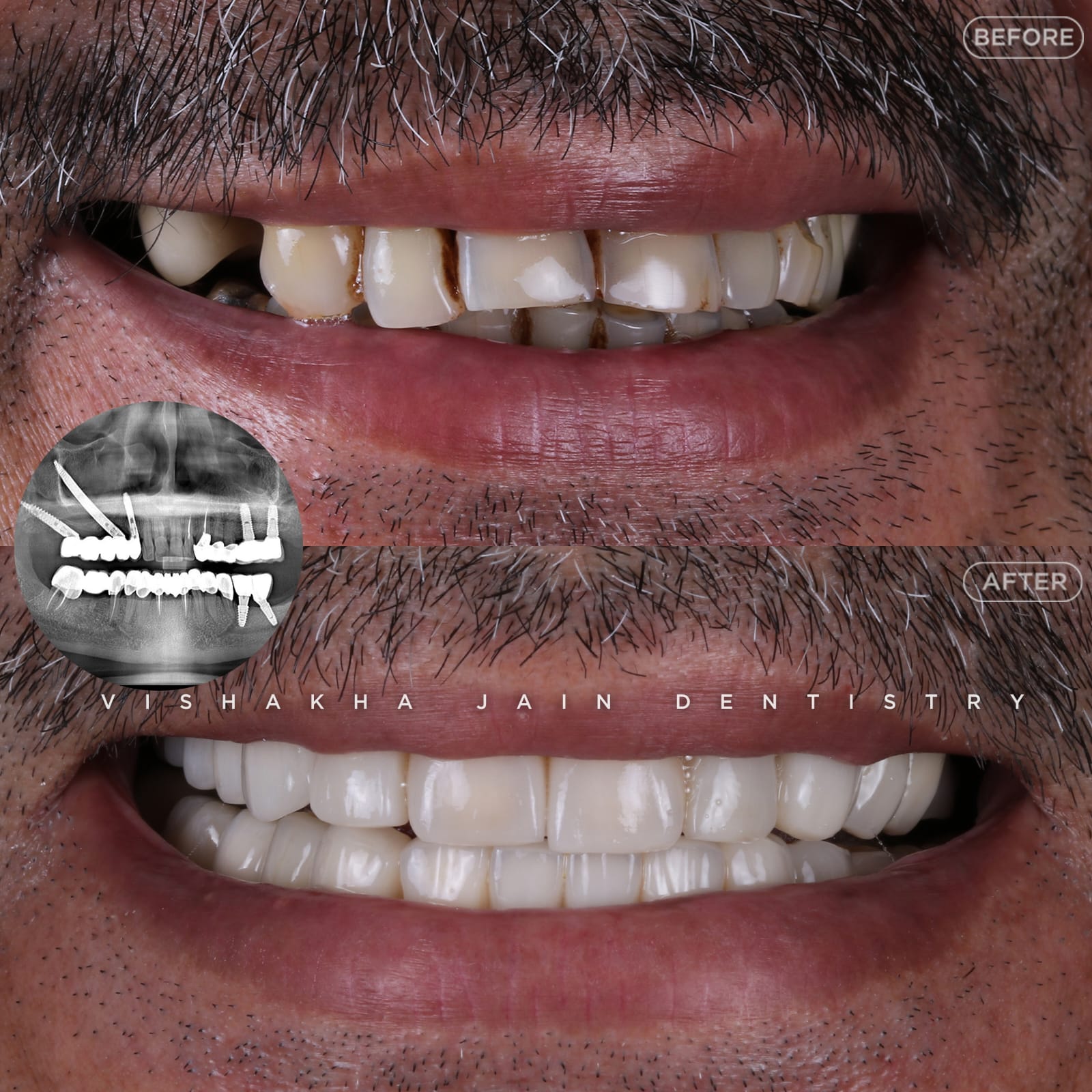 Smile Makeover Treatment In Indore 176250164210