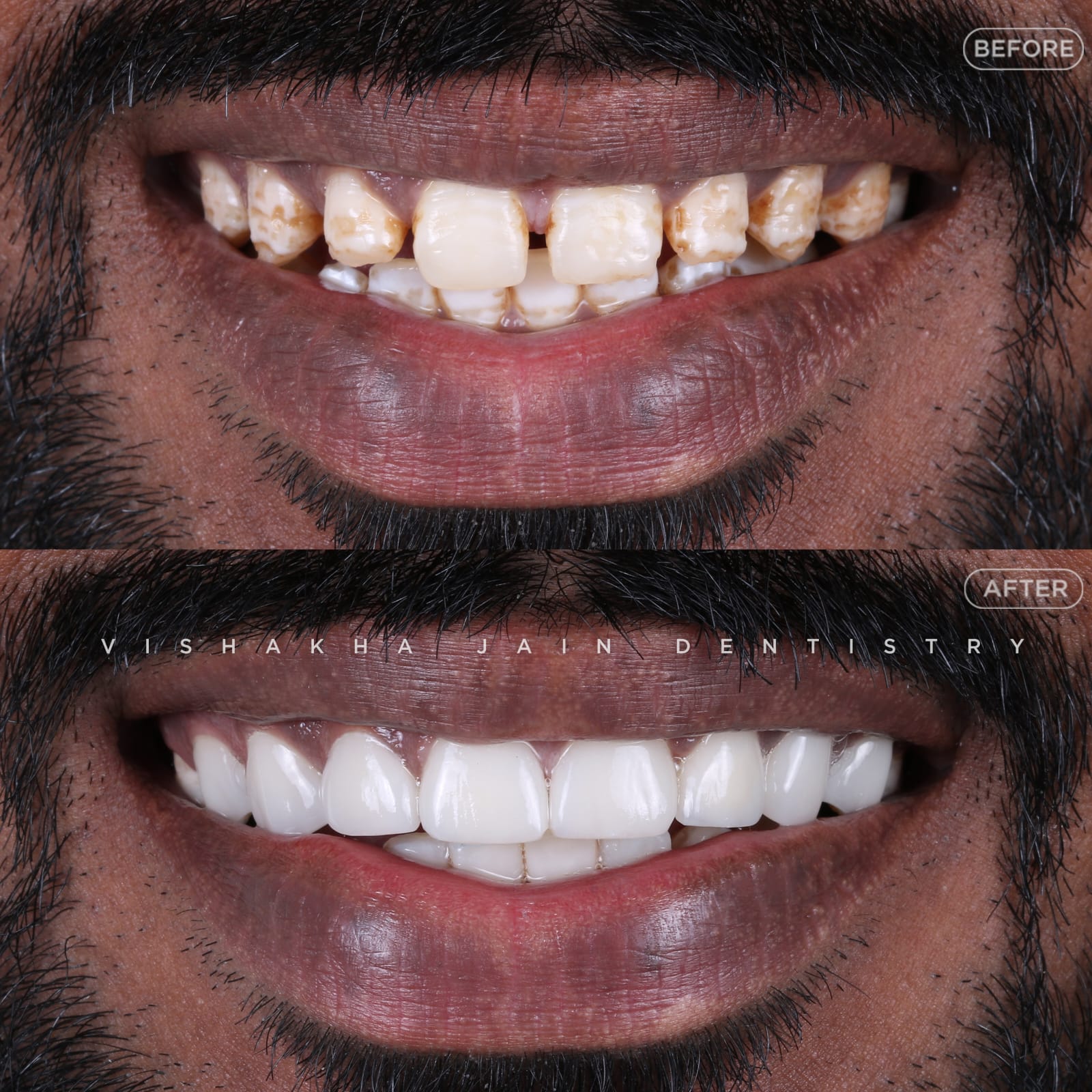 Smile Makeover Treatment In Indore 17625016430