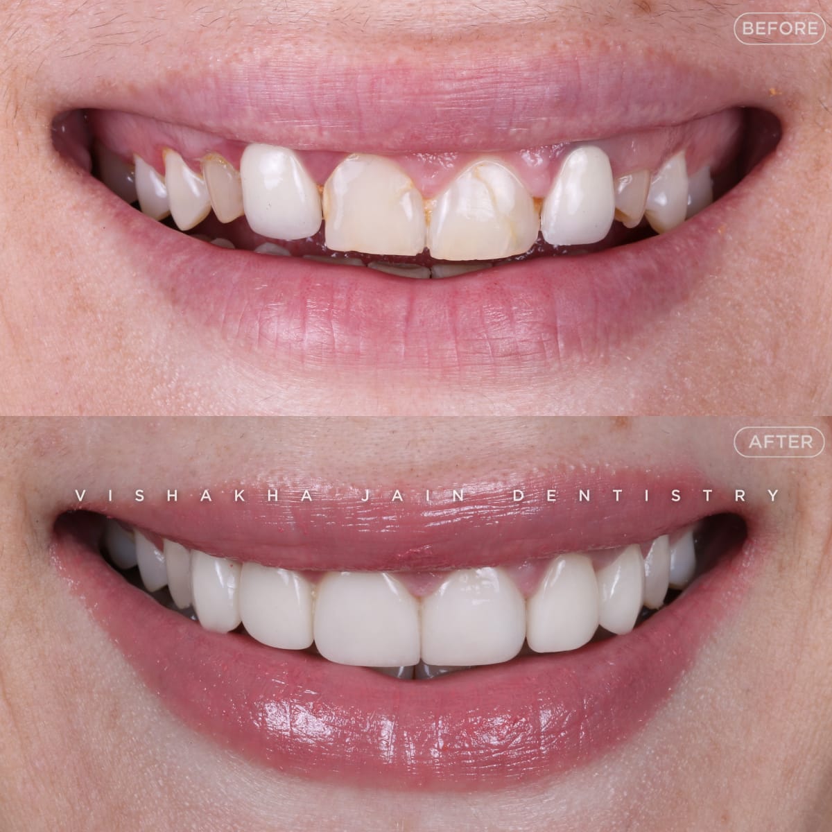 Smile Makeover Treatment In Indore 17625016433