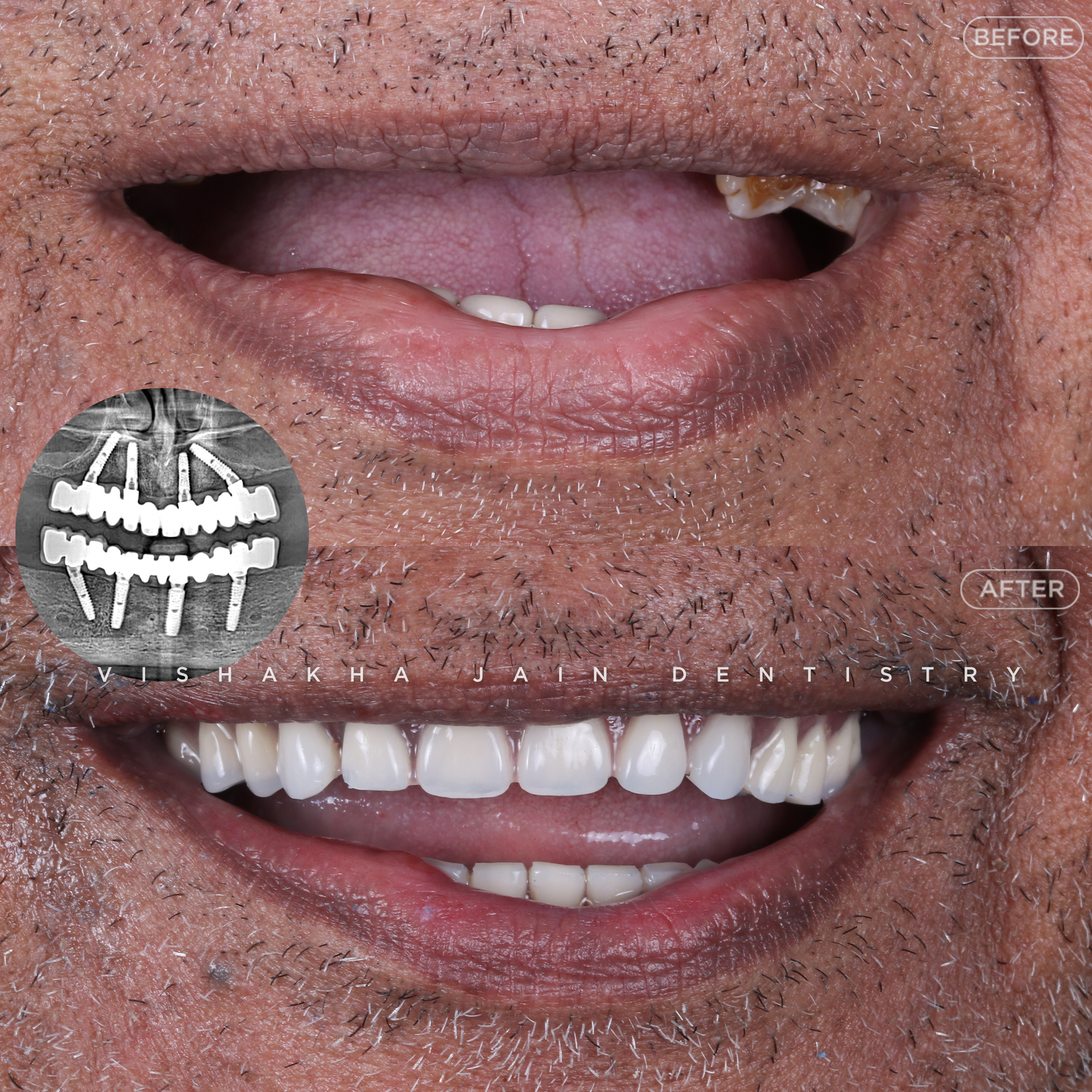 Smile Makeover Treatment In Indore 17625016438