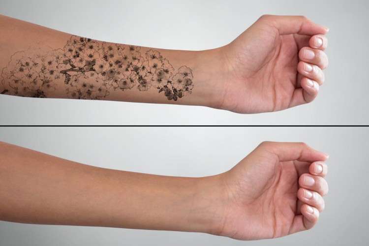 Tattoo Removal Market Report 16428306375