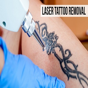 Tattoo Removal Treatment In Hyderabad 16868113647