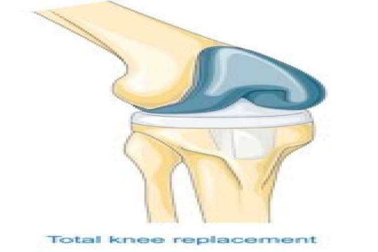 Total Knee Replacement Surgery In Hyderabad 16457029524