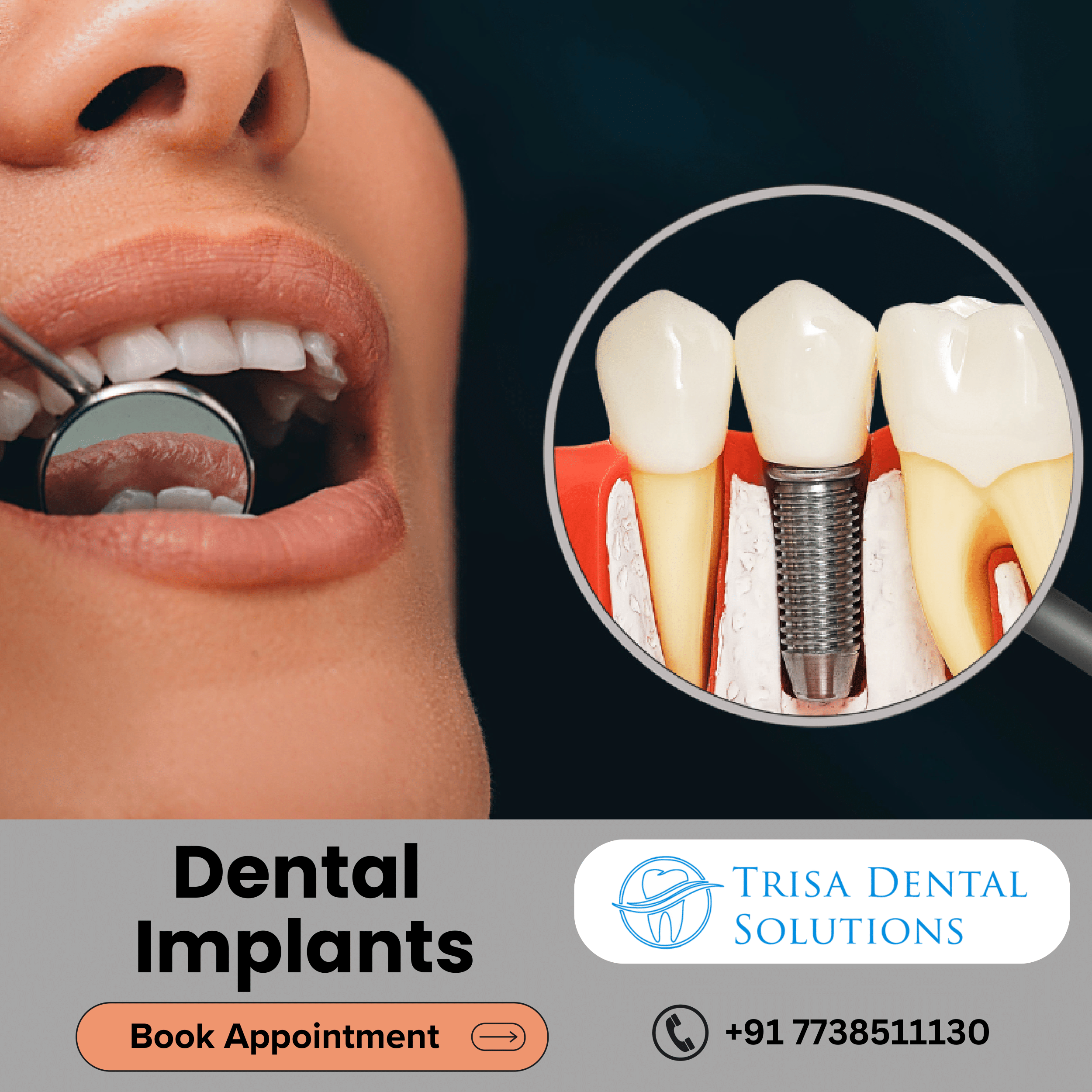 Trisa Dental Solutions Best Dental Implants Clinic In Mumbai 17446243758