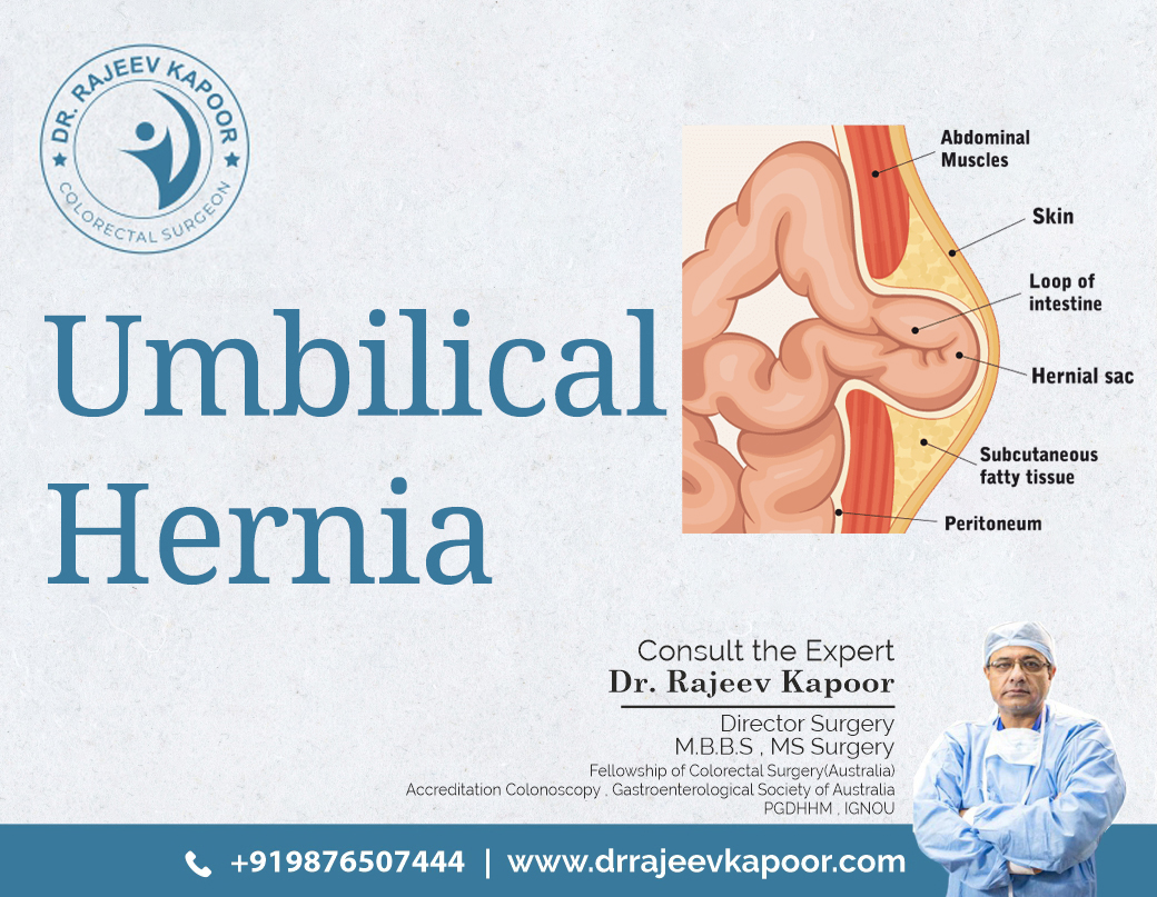 Umbilical Hernia Surgeon In Chandigarh 16735078591