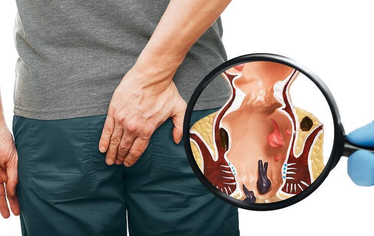 Ayurvedic piles treatment hospital in bangalore