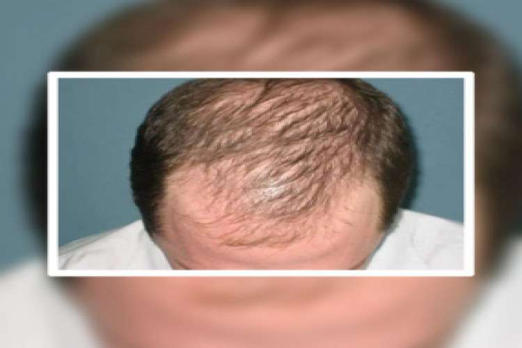 Best Hair Transplant Clinic in India