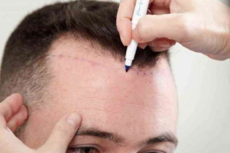 Best Hair Transplant in Jaipur