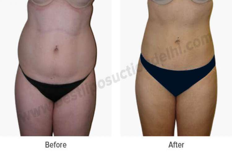 Best Liposuciton Surgery in Delhi at LA Clinic