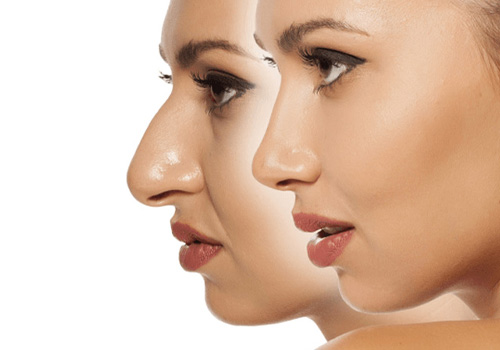Best Surgeon For Nose Job Surgery In Hyderabad