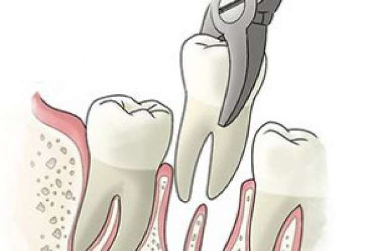 Braces Treatment Cost