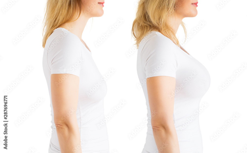 Breast Augmentation in Delhi