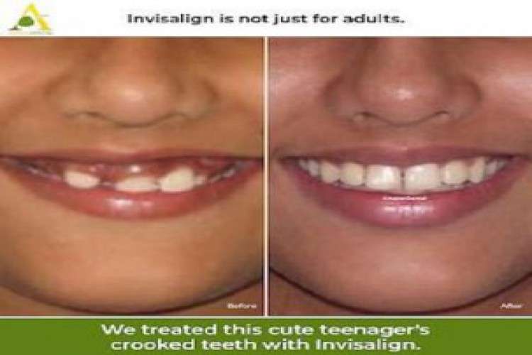 Cosmetic Dental Procedures for Restoring Teeth
