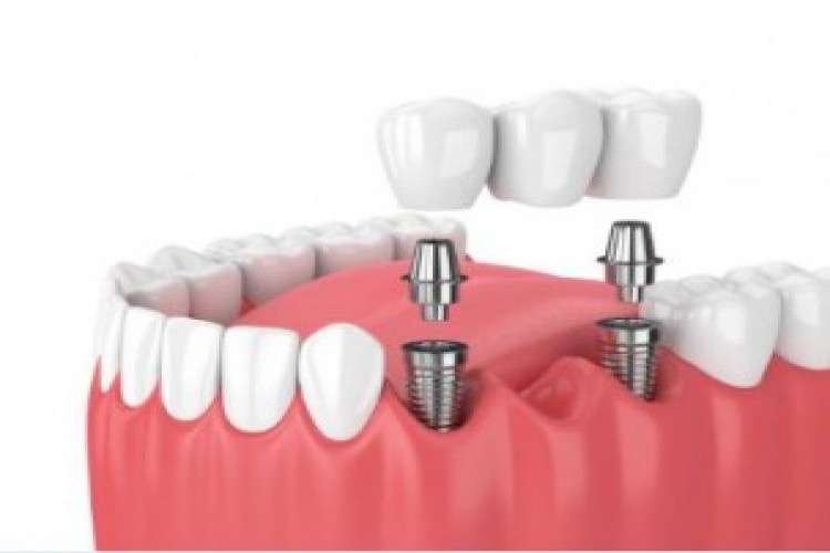 Dental implant cost in chennai   Akeela Dental Care