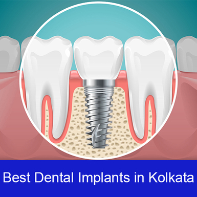 Dental Implant In Kolkata Best Dental Implant In Kolkata