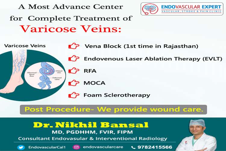Dr Nikhil Bansal offers Varicose veins treatment