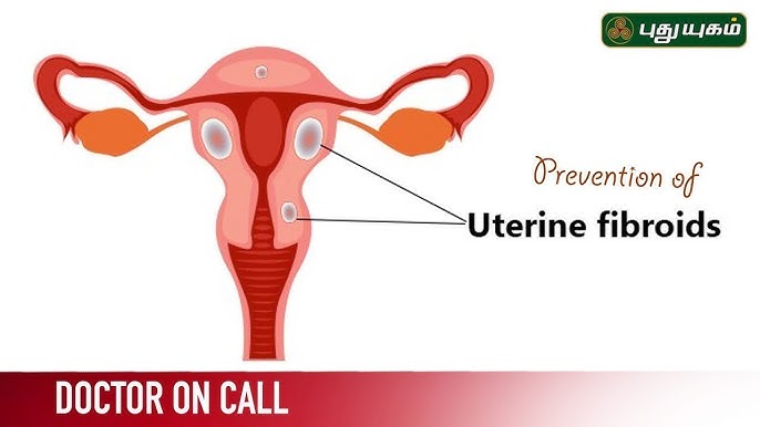 Find uterine fibroid embolization near me  irfacilities